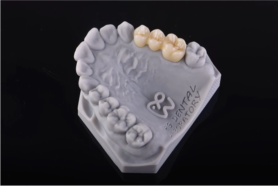 Posterior dental bridge on a dental model