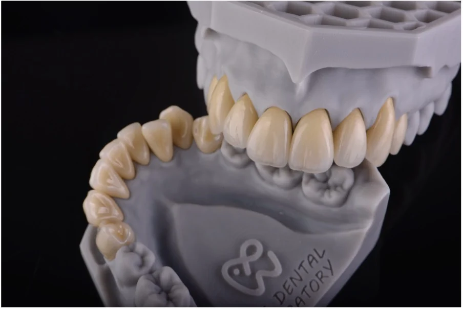 Close-up of detailed crown restorations on a dental model